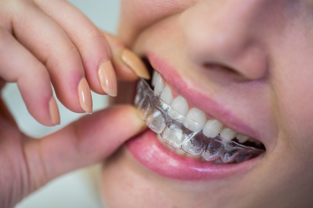 Comparing Traditional Braces vs. Clear Aligners: Which Is worth the Investment?