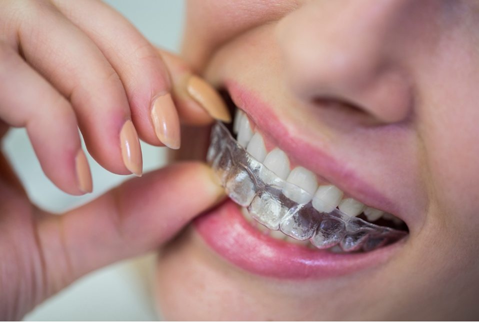 dental braces in gurgaon