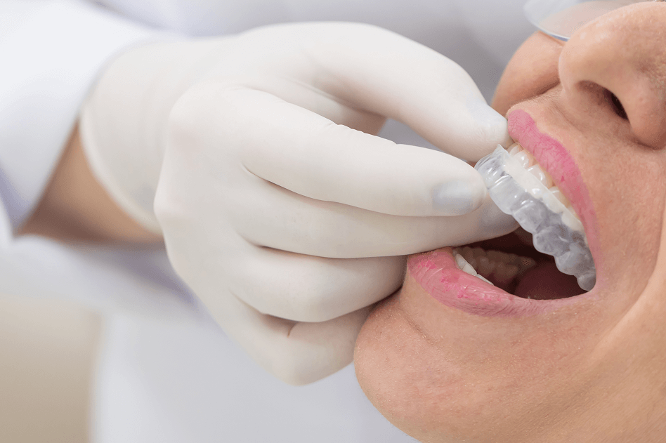 Why Choose an Orthodontist for Clear Aligners Over a General Dentist