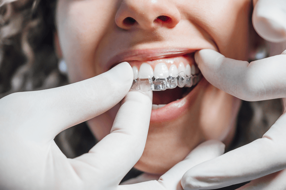 invisalign-vs-cheap-aligners-in-gurgaon-cost-vs-results-comparison